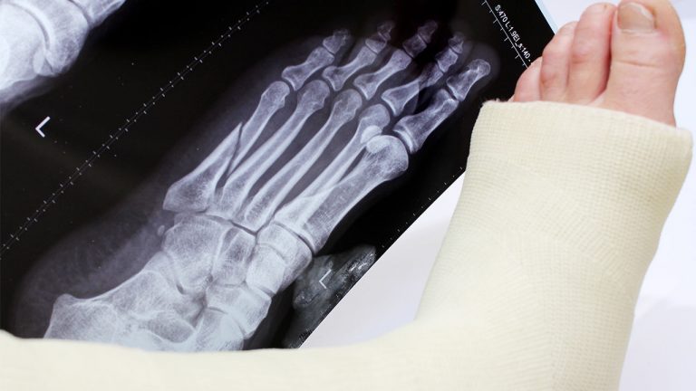 Broken foot in a cast next to an x-ray